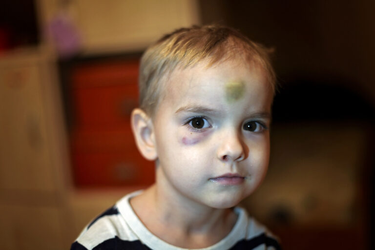 Kids get hurt - kids need help -Chiropractic care for kids